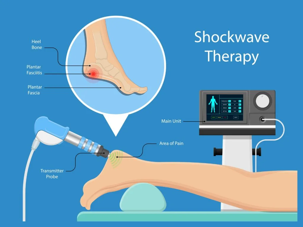 shockwave-treatment-plantar-fasciitis-london-ontario